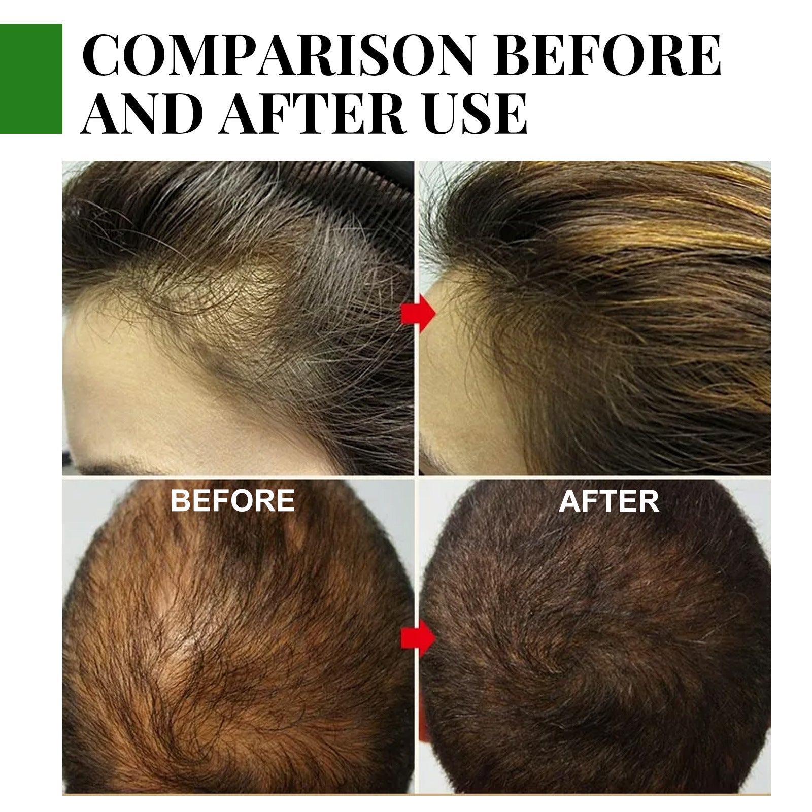 Comparison before and after use of Rosemary Hair Oil showing hair restoration and improved fullness.